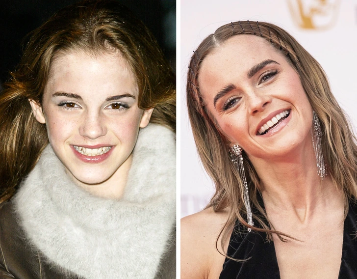 Emma Watson con Brackets | Dental Trendy