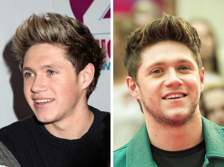 Niall Horan con Brackets | Dental Trendy