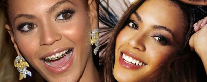 Beyonce con Brackets | Dental Trendy