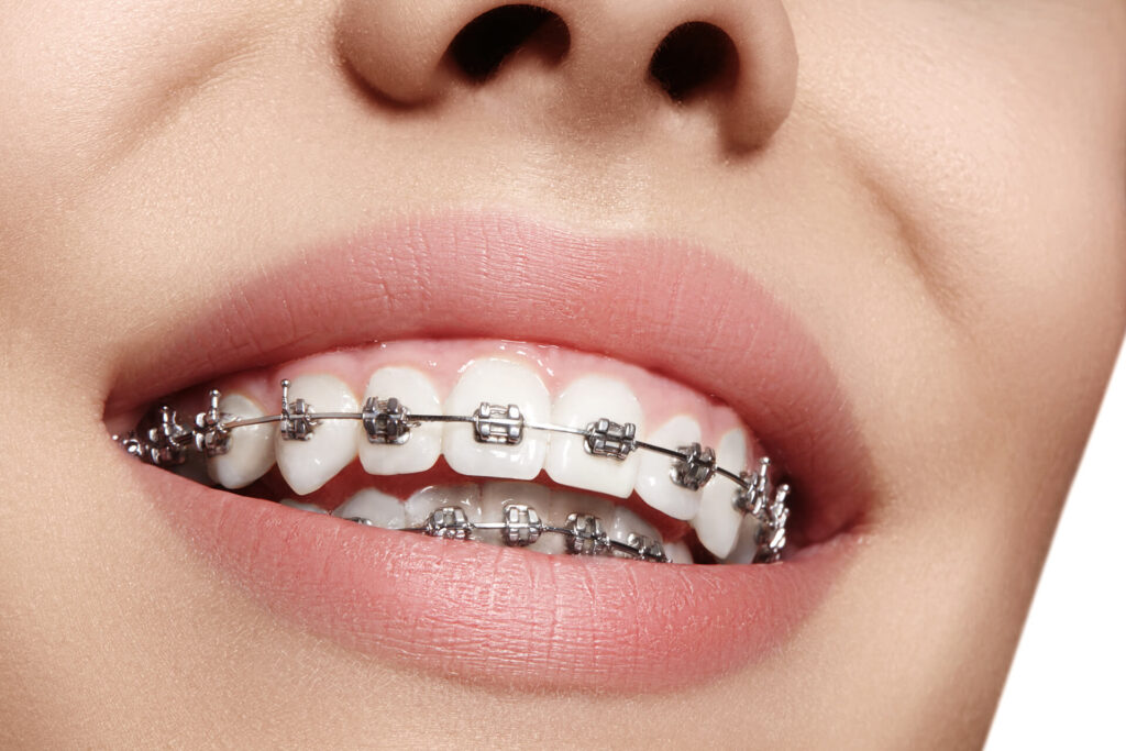 Qué son los Brakets | Dental Trendy