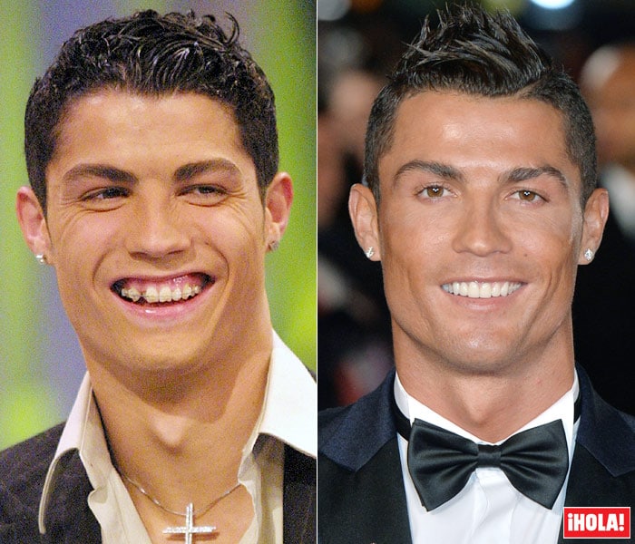 Cristiano Ronaldo con Brackets | Dental Trendy