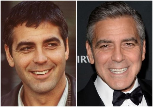 George Clooney Brackets | Dental Trendy