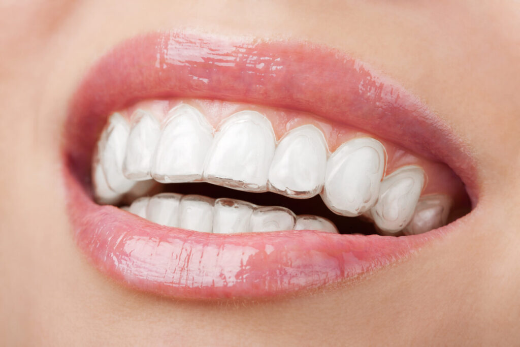 Invisaling | Beneficios | DentalTrendy