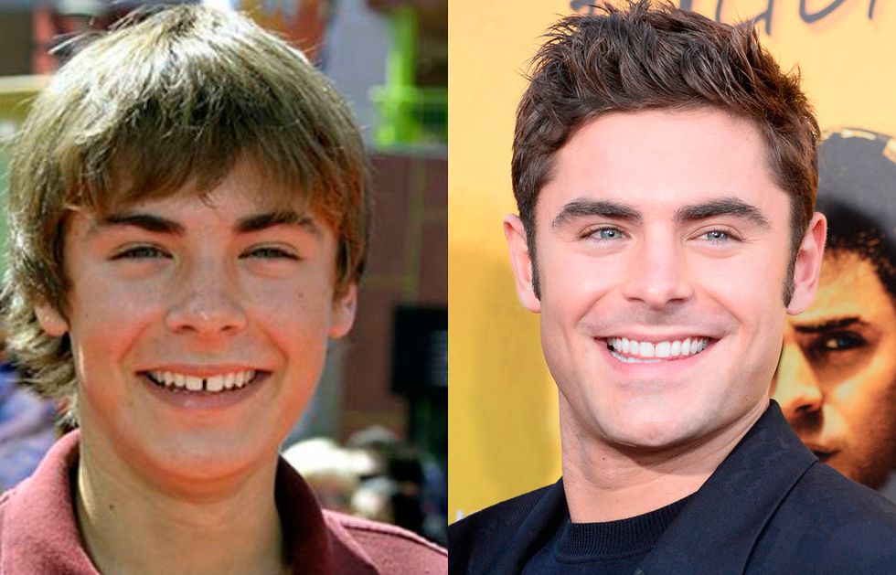 Zac Efron con Brackets | Dental Trendy